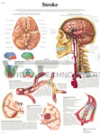 Stroke - Anatomical Chart